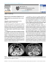 Scholarly article on topic 'Mesenteritis esclerosante idiopática en la edad pediátrica: presentación de un caso clínico'