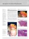 Scholarly article on topic 'Giant squamous cell carcinoma in HIV-positive patient'