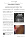 Scholarly article on topic 'One-step Hysteroscopic Removal of Large Sinking Submucous Myoma'