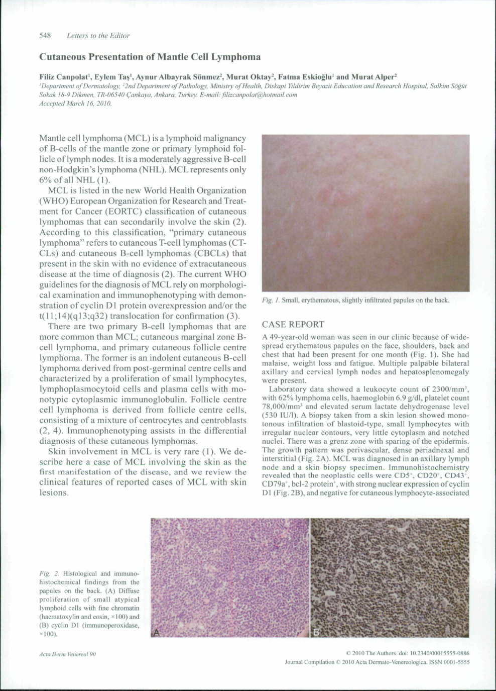 Cutaneous Presentation Of Mantle Cell Lymphoma Topic Of Research Paper In Clinical Medicine Download Scholarly Article Pdf And Read For Free On Cyberleninka Open Science Hub